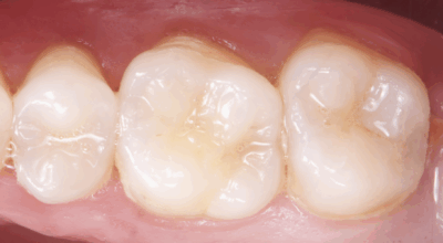 Cabinet EDTM - pulpotomie partielle - Endodontie - 1