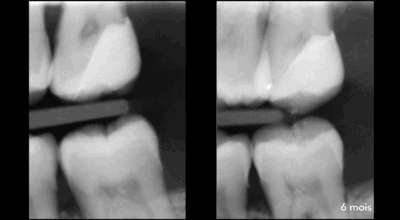 Cabinet EDTM - pulpotomie partielle - Endodontie - 10