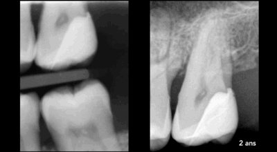 Cabinet EDTM - pulpotomie partielle - Endodontie - 11