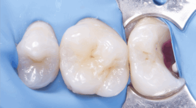 Cabinet EDTM - pulpotomie partielle - Endodontie - 2