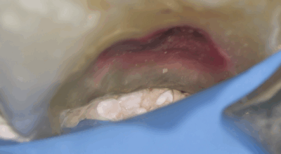 Cabinet EDTM - pulpotomie partielle - Endodontie - 3