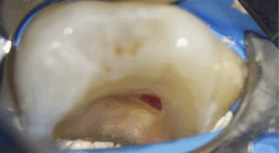 Cabinet EDTM - pulpotomie partielle - Endodontie - 4