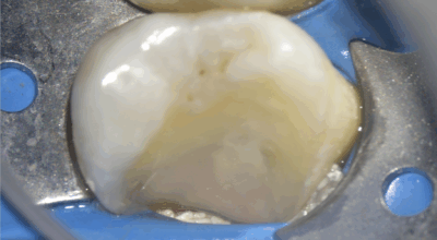 Cabinet EDTM - pulpotomie partielle - Endodontie - 6