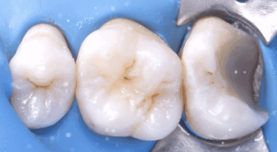 Cabinet EDTM - pulpotomie partielle - Endodontie - 7