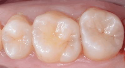 Cabinet EDTM - pulpotomie partielle - Endodontie - 8