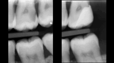 Cabinet EDTM - pulpotomie partielle - Endodontie - 9