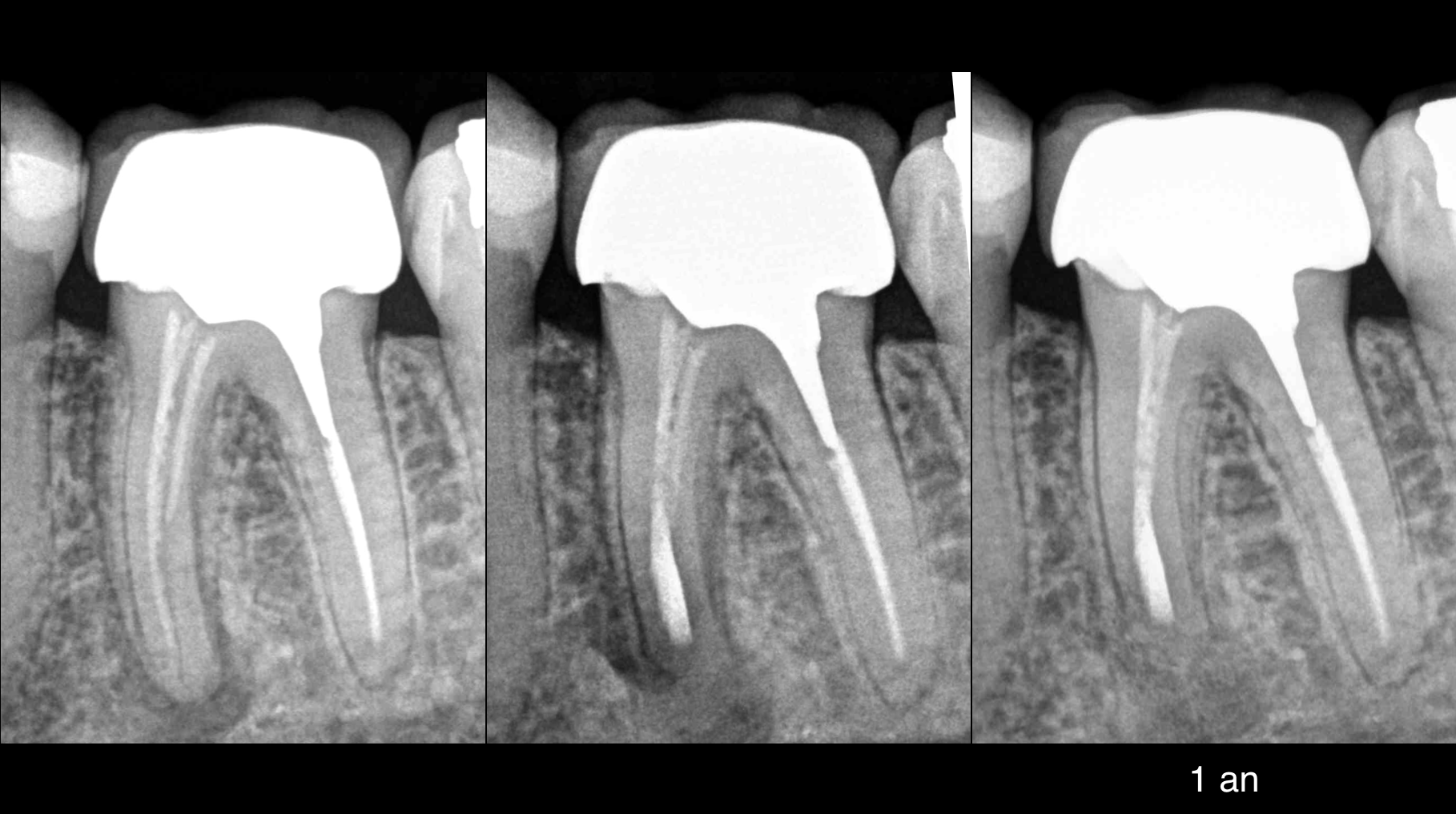 Cas - chirurgie endodontique - cabinet EDTM - Dr Brice Riera