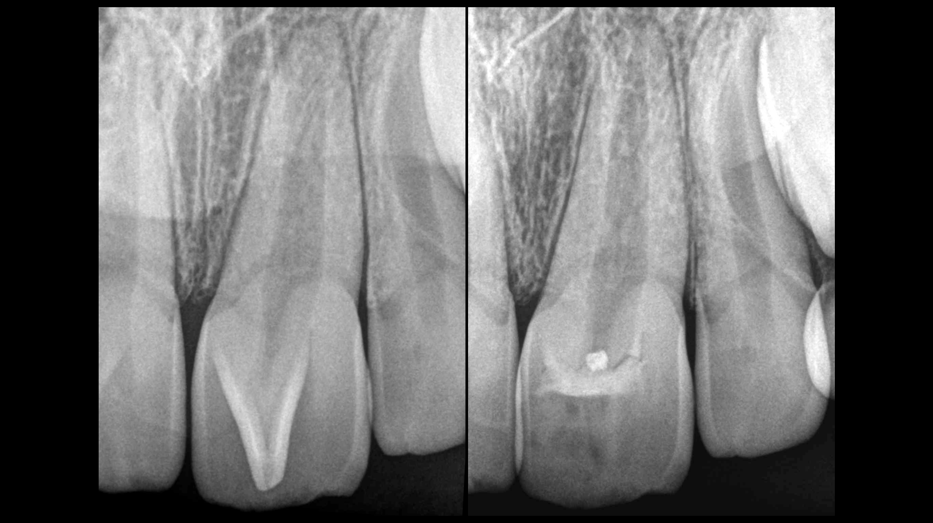 Coiffage pulpaire direct - cabinet edtm - endodontie