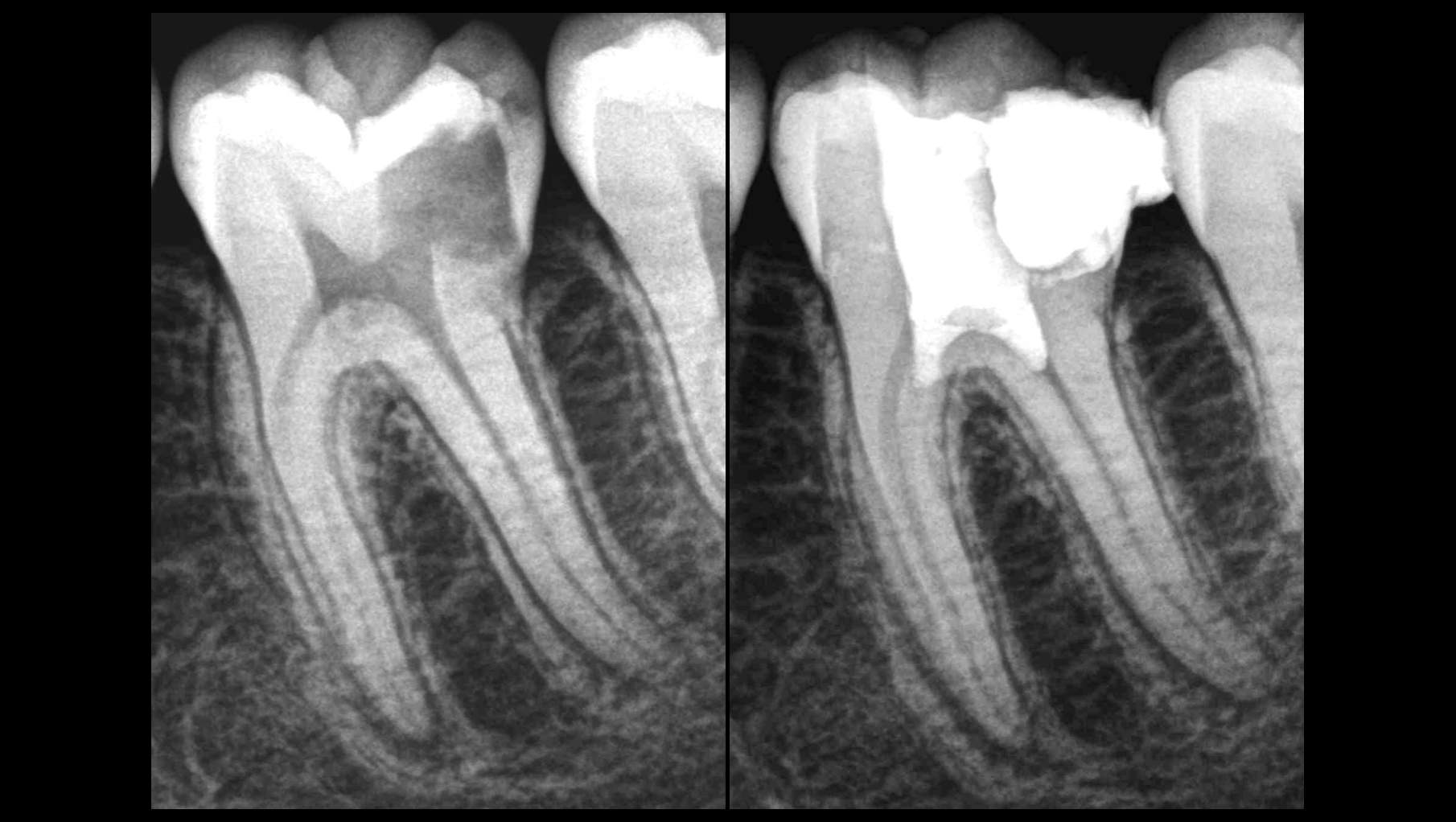 Pulpotomie totale - cas - cabinet edtm - endodontie