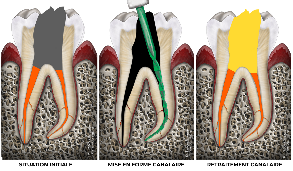 retraitement canalaire - cabinet EDTM - Endodontie Paris