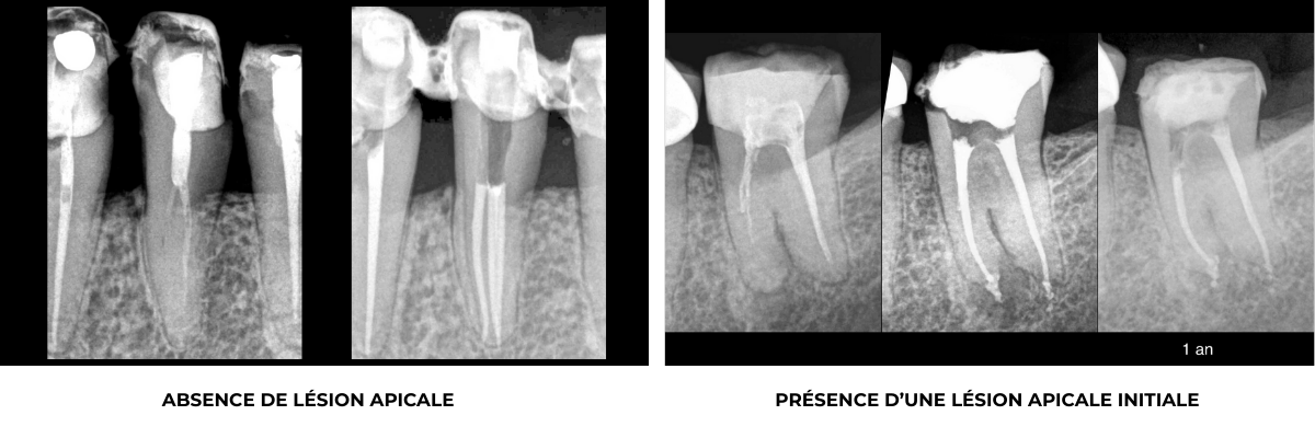 retraitment canalaire - cabinet EDTM - Endodontie - paris