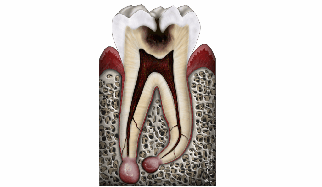 traitement canalaire - pulpe necrosee - cabinet edtm