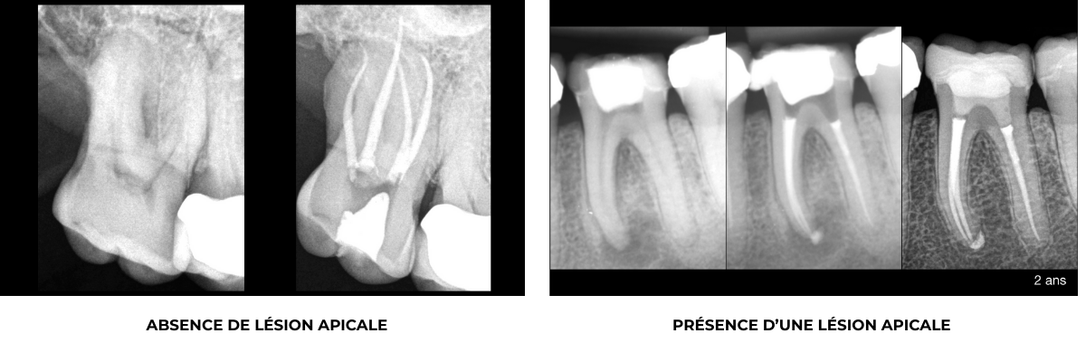 traitement canalaire - cas - cabinet EDTM - Paris Pereire 2