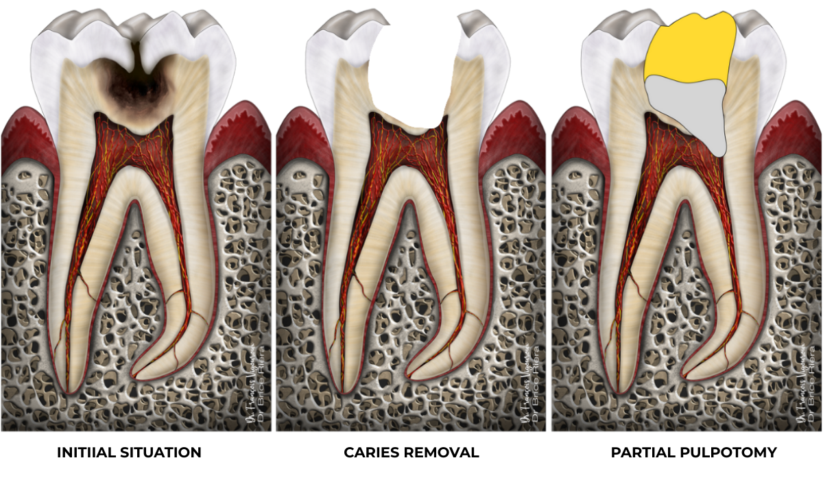 Partial pulpotomy edtm paris