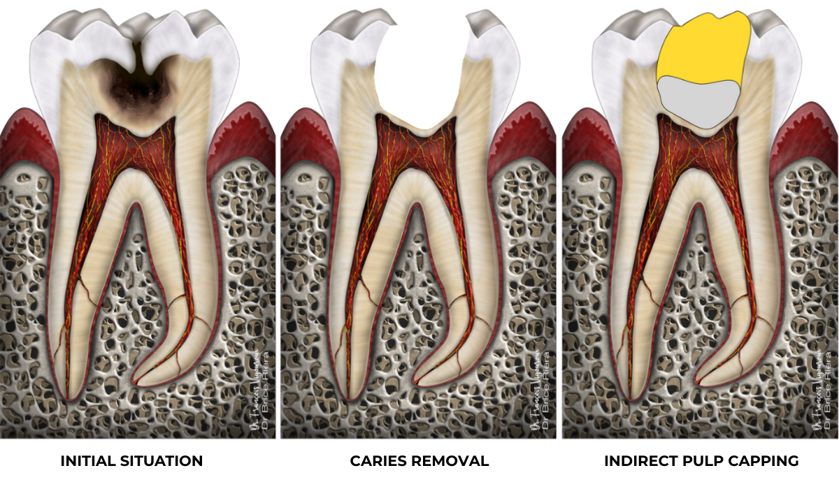Indirect pulp capping (2) - EDTM Practice - Endodontics - Paris