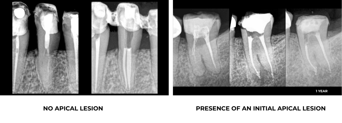 root canal retreatment - EDTM practice - Endodontics - Paris