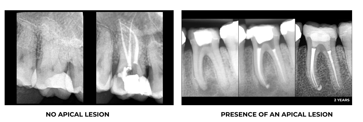 root canal treatment - case - EDTM practice - Paris Pereire 2