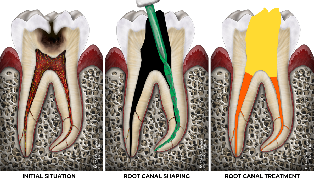 root canal treatment - EDTM practice - Endodontics - Paris