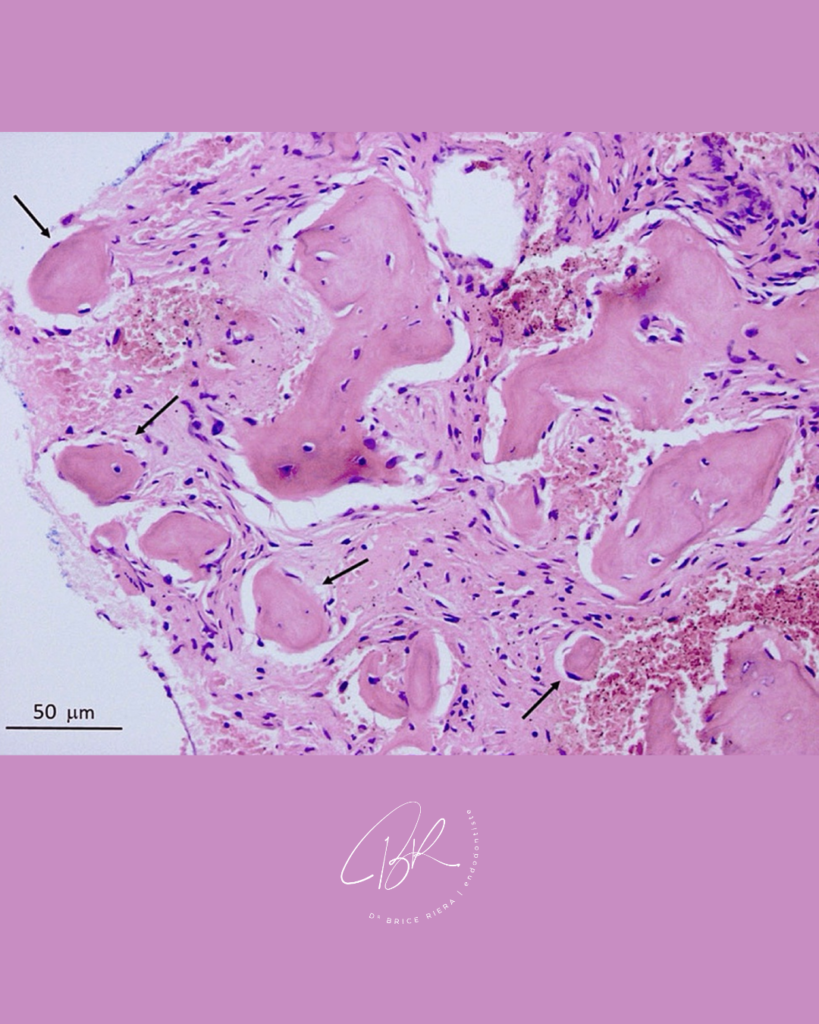Blog Edtm - Dysplasie cémento-osseuse péri-apicale en histologie