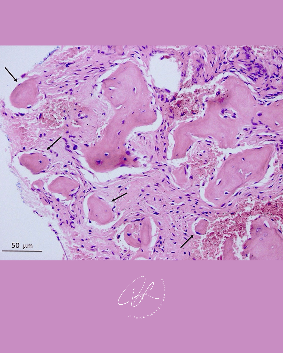 Blog Edtm - Dysplasie cémento-osseuse péri-apicale en histologie
