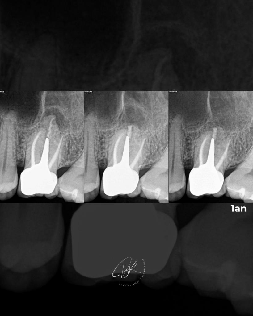 Cas - chirurgie endodontique de la racine palatine - cabinet edtm paris endodontie