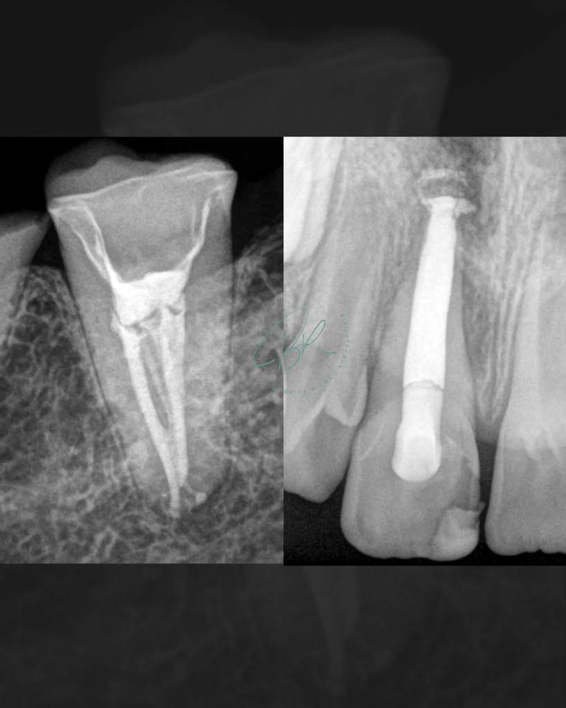 Cas post biocéram ciment - dr brice riera - edtm