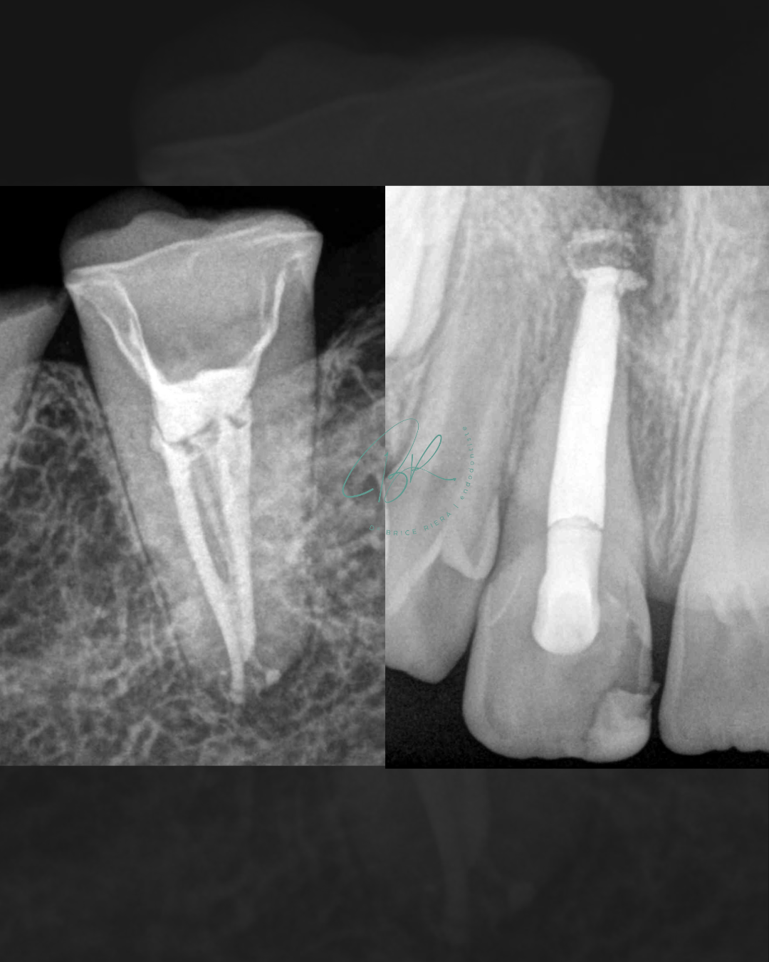 Cas post biocéram ciment - dr brice riera - edtm