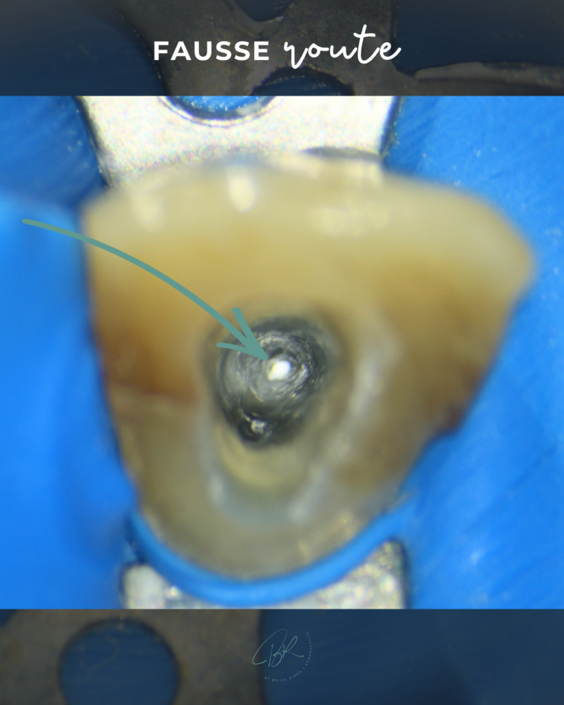 Fausse route - endodontie - cabinet edtm
