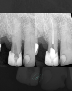 fausse route en endodontie cabinet edtm