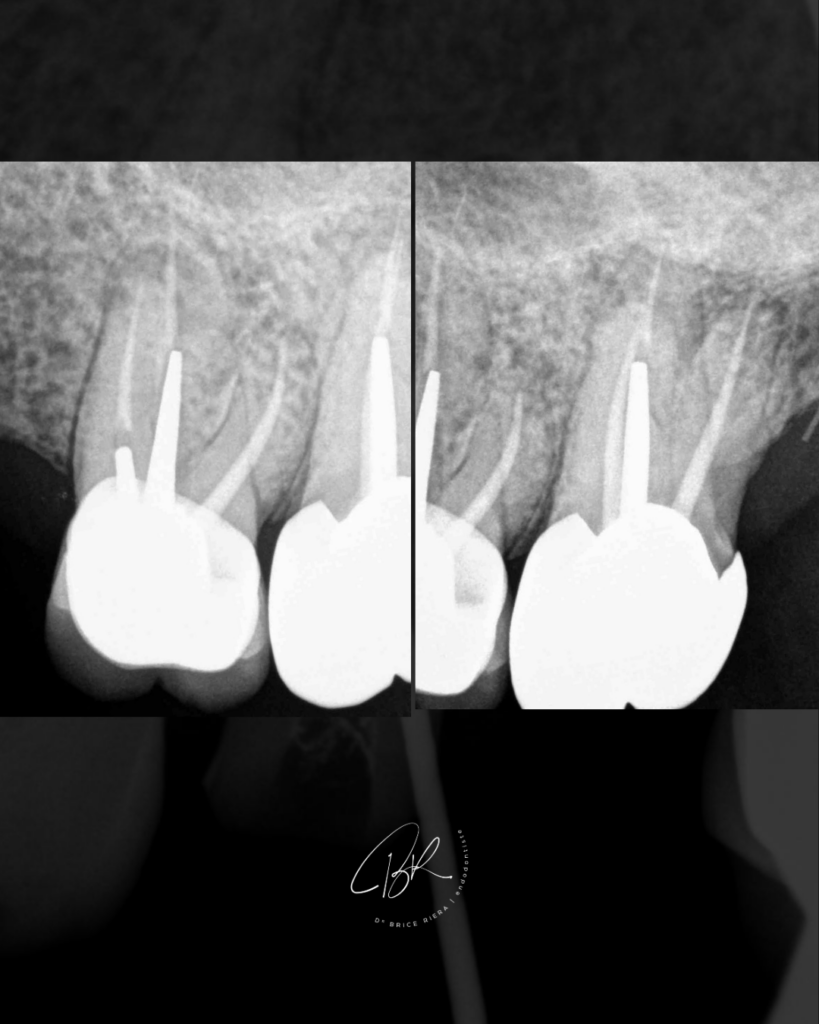 Cas edtm endodontie