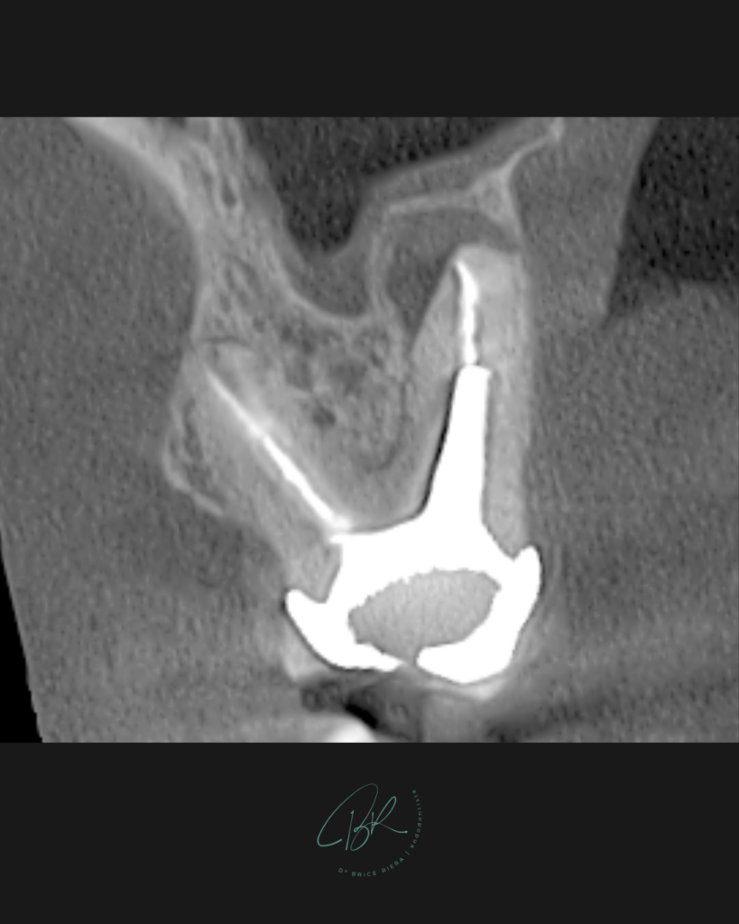 Chirurgie endodontique et anatomie - cabinet edtm