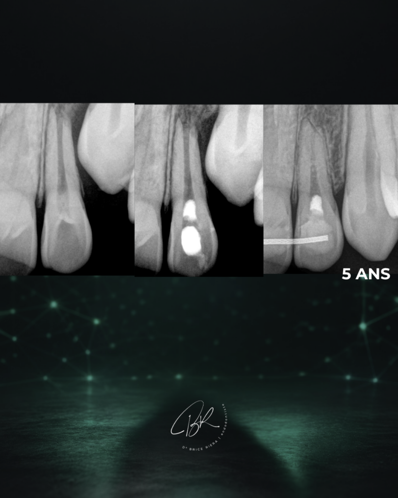 Cas revitalisation dent immature - Dr Brice Riera EDTM - Endo Paris