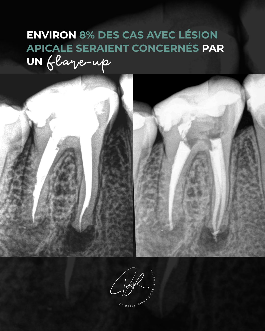 Flare up en endodontie - definitions - blog edtm - endodontie paris