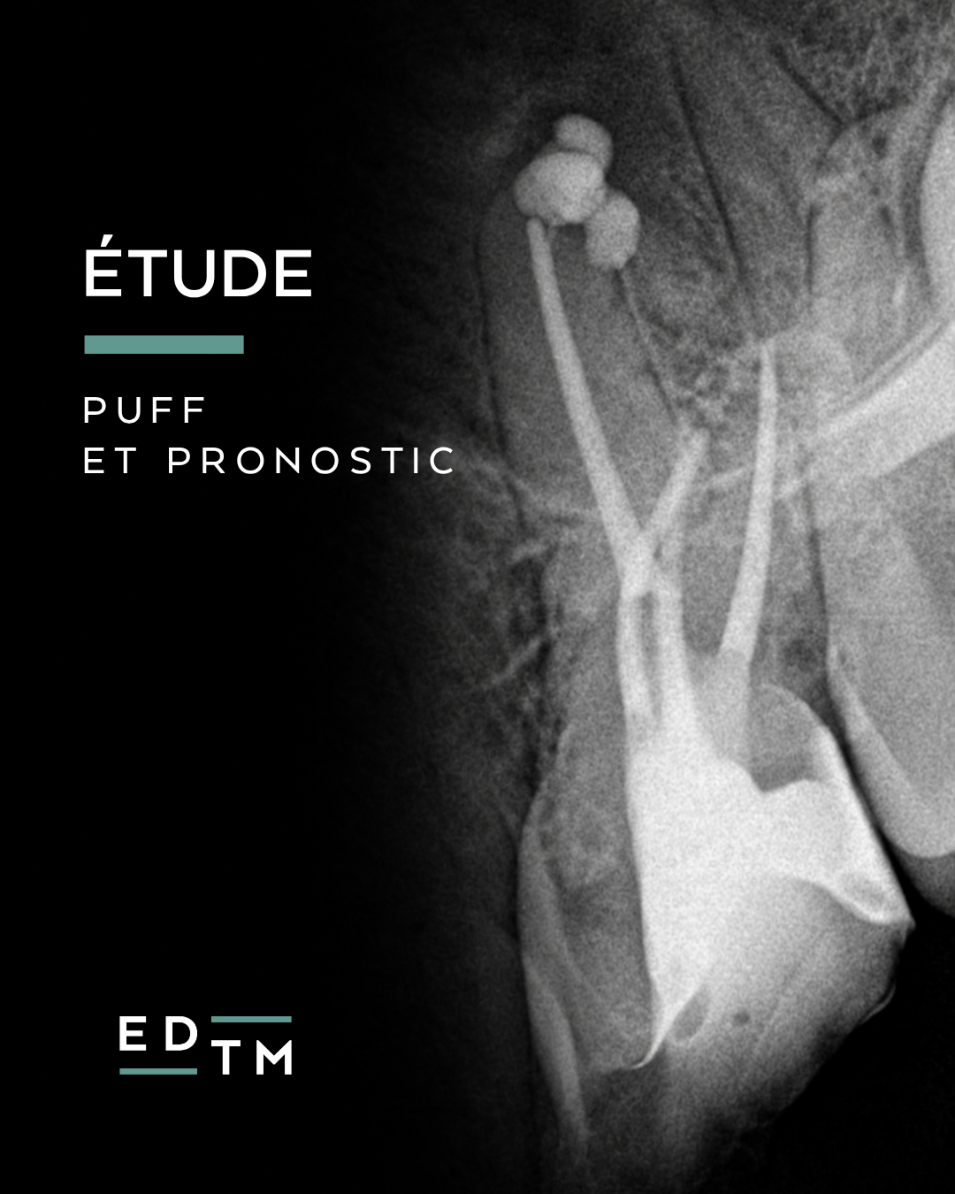 Etude puff et pronostic - dr matteo amar - edtm - cabinet endodontie